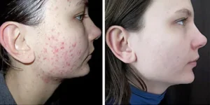 IPL acne treatment 2 1