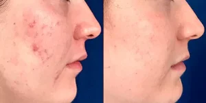 IPL acne treatment 4