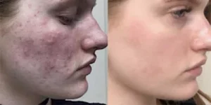 IPL acne treatment 5 1
