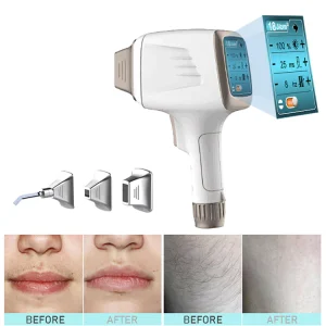 diode laser CH hair removal