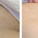 laser hair removal by beauty device 9 1