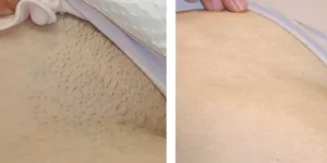 laser hair removal by beauty device 9 1