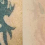 laser tattoo removal by nd yag laser 3 1
