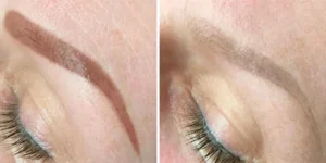 laser tattoo removal by nd yag laser 4 2