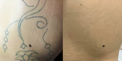 laser tattoo removal by nd yag laser 6
