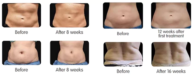 Cryolipolysis Machine Fat Freezing effect