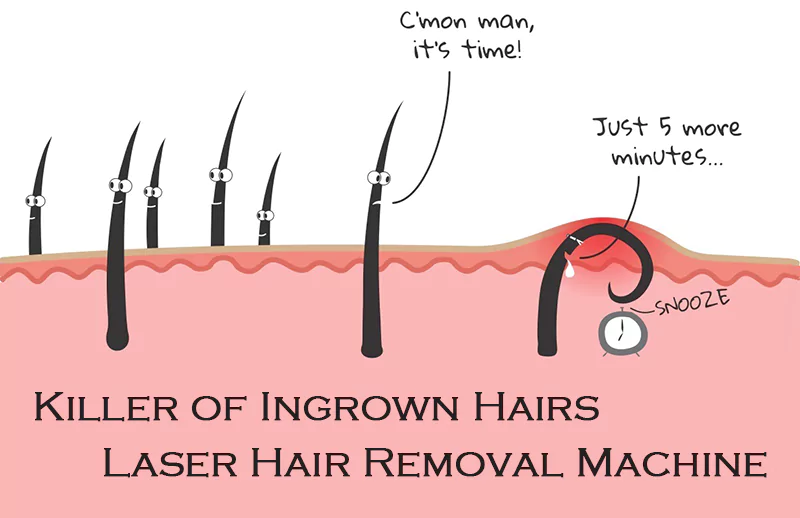 1. Causes of ingrown hair - wide 4