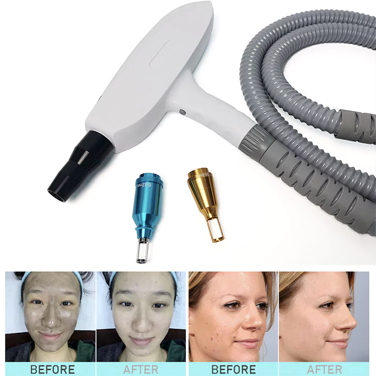 NDYAG tattoo removal carbon peel