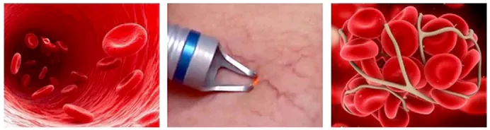 broken vein removal machine working theory 3