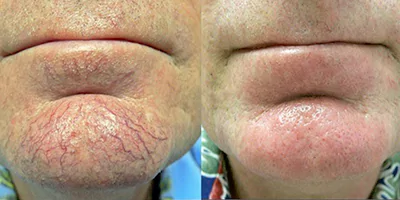 diode laser 980nm spider vein removal (2)