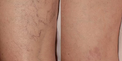 Vascular treatment for leg