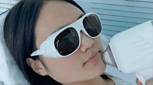 facial hair removal by diode laser