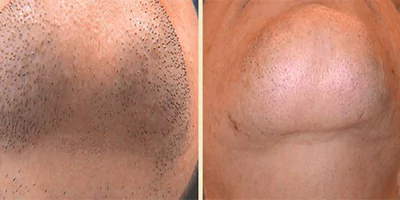 Chin laser hair removal