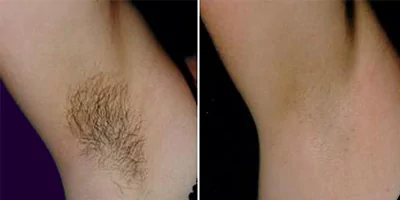 laser hair removal by beauty device (10)