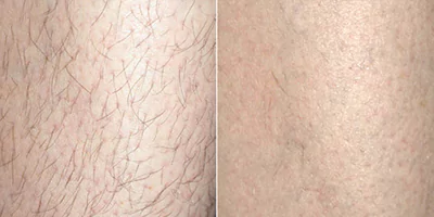 Leg depilation effect