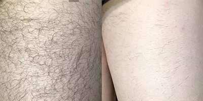 Leg hair removal