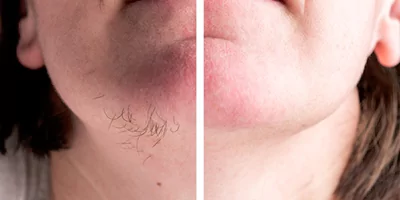 Beard hair removal