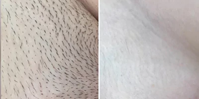 Bikini hair removal
