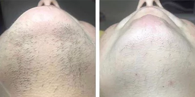 Chin laser hair removal