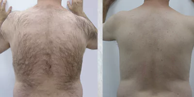 Men back hair reduction