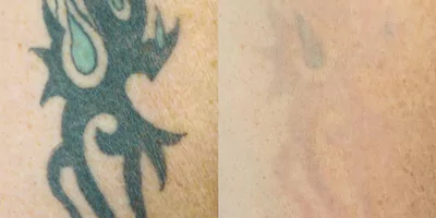 Tattoo removal