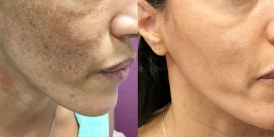Pigmentation treatment